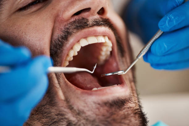 Best Emergency Root Canal Treatment in Chevy Chase, MD